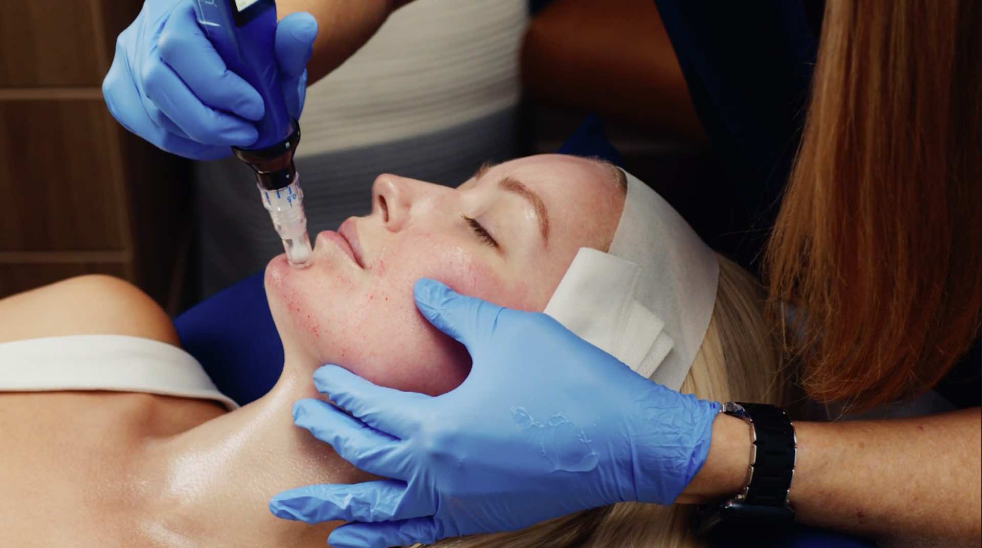 dermapen birmingham